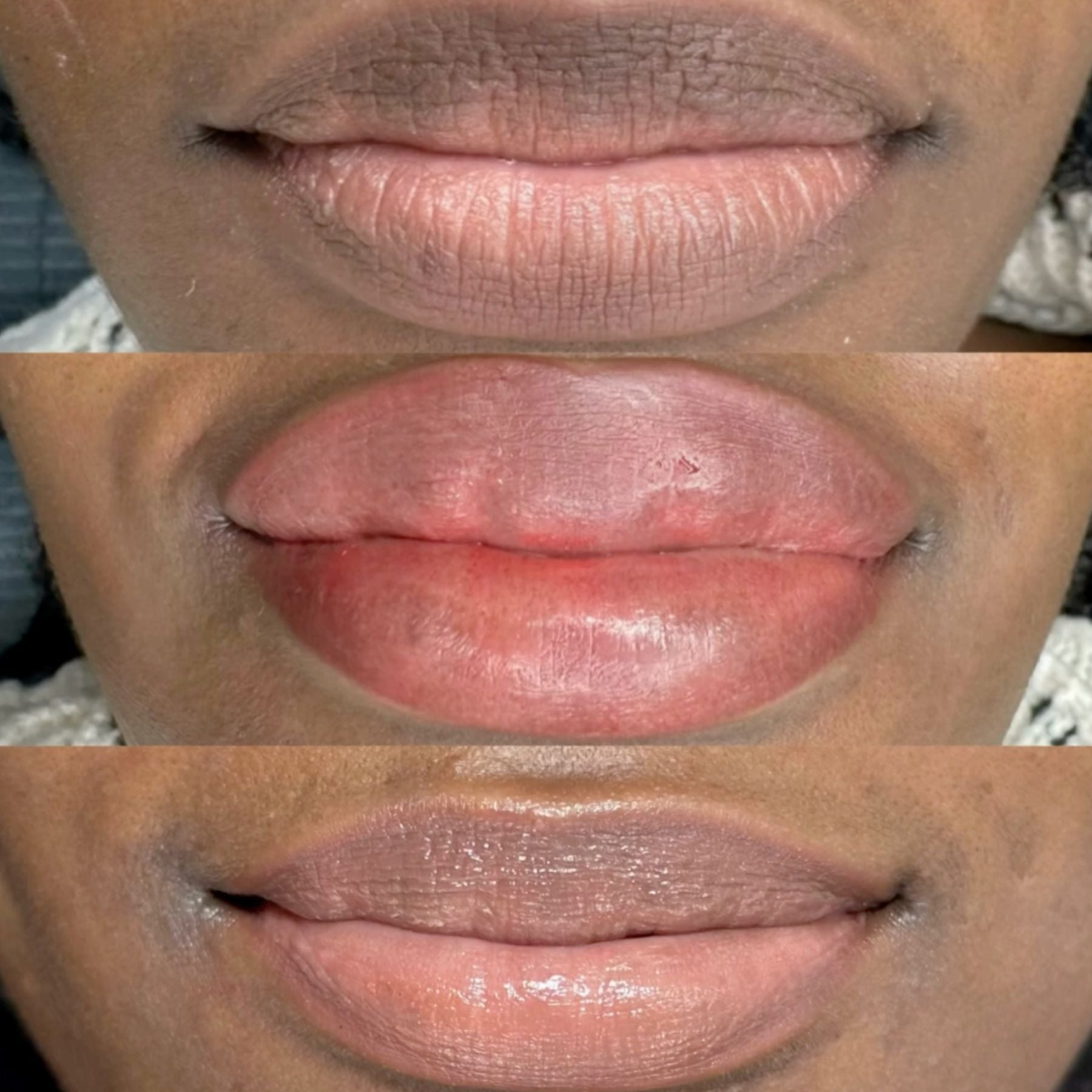 Fitz 6 Dark Lip Neutralization: Kurty’s Case Study - Tina Davies Professional