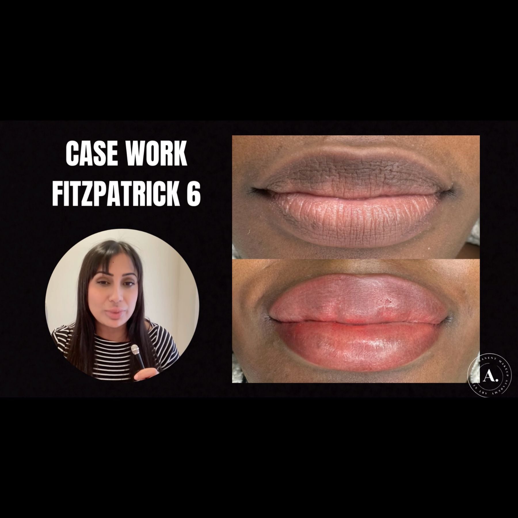 Fitz 6 Dark Lip Neutralization: Kurty’s Case Study - Tina Davies Professional