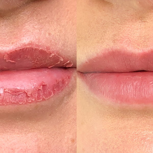 Anjana's Aesthetics & Laser - Lip Blush tattoo healing process!! The lips  will look very dry and chapped as they heal.The colour gets lighter, and  then as the skin heals, it comes