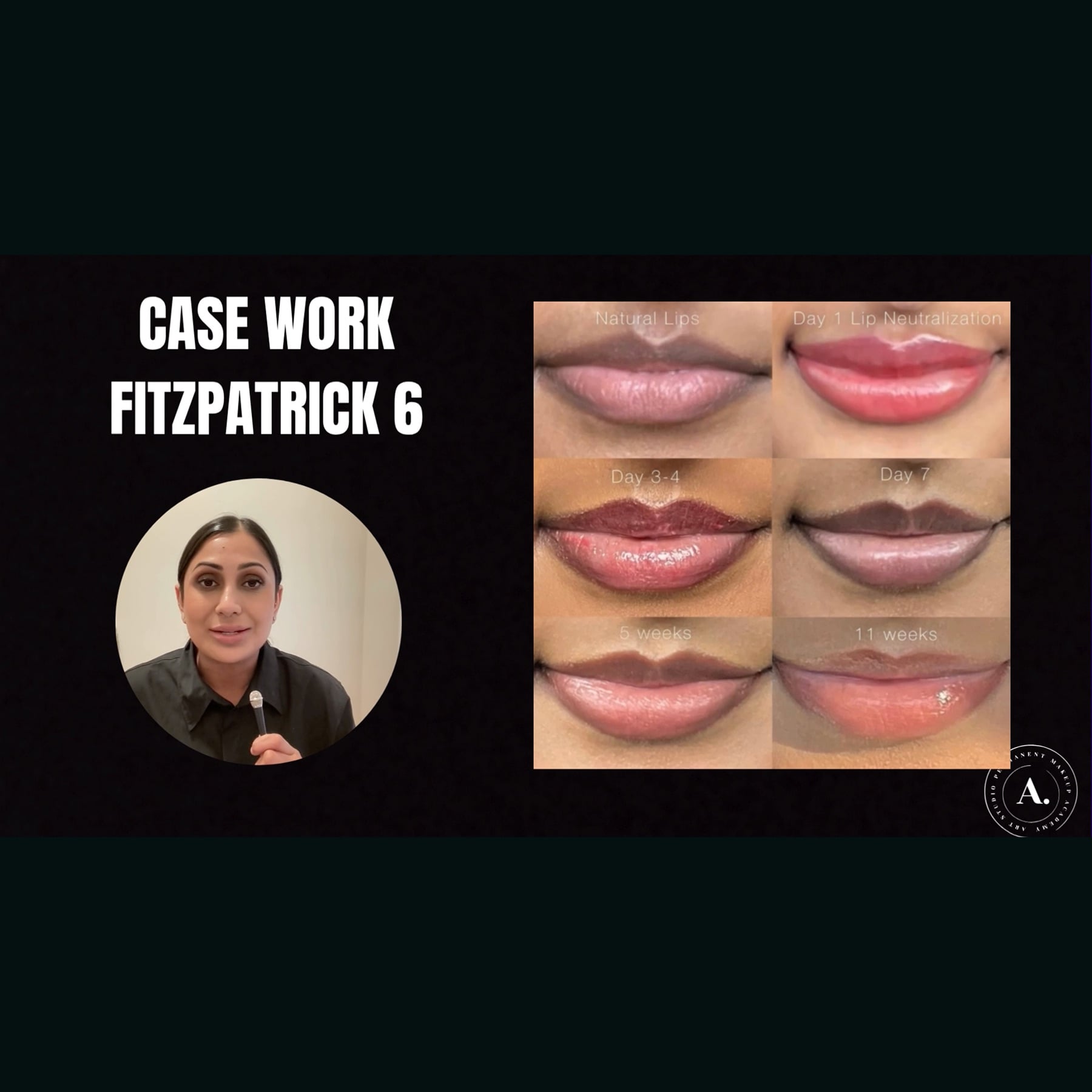 Fitz 5 Dark Lip Neutralization: Anita's Case Study by Amanda Rakhra - Tina Davies Professional