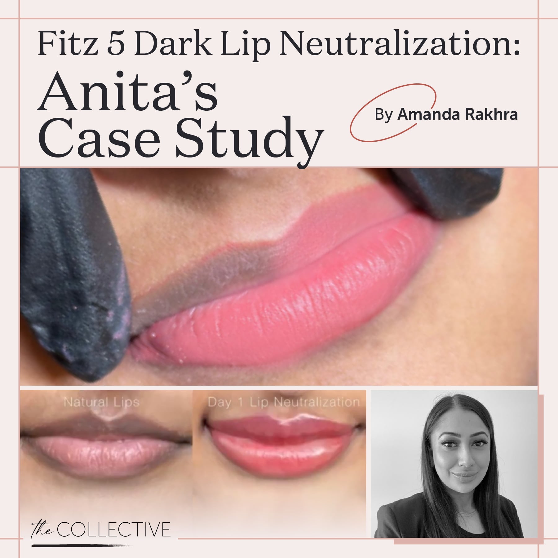 Fitz 5 Dark Lip Neutralization: Anita's Case Study by Amanda Rakhra - Tina Davies Professional